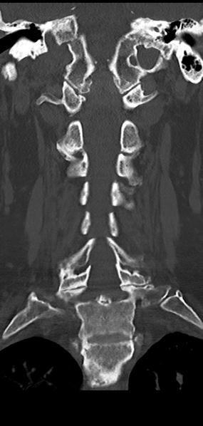 File:Cervical spine fracture - chalk stick (Radiopaedia 39116-41323 Coronal bone window 27).png
