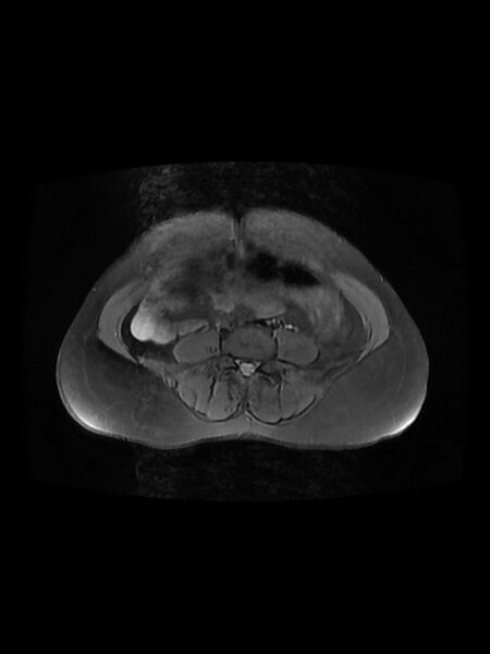 File:Cesarean section scar endometrioma (Radiopaedia 56569-63297 Axial PD fat sat 2).jpg