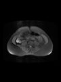 Cesarean section scar endometrioma (Radiopaedia 56569-63297 Axial PD fat sat 2).jpg