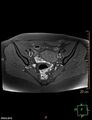 Cesarian scar endometriosis (Radiopaedia 68495-78066 Axial T1 fat sat 10).jpg