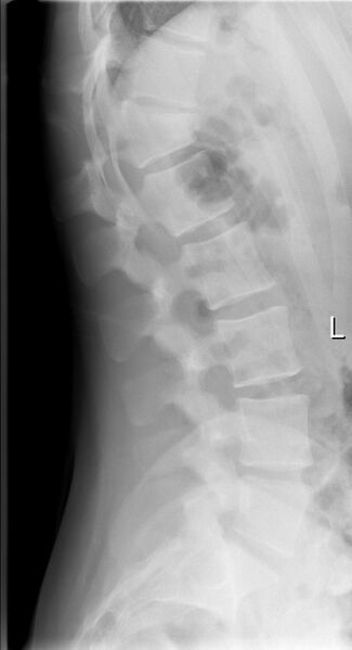File:Chance fracture (Radiopaedia 45345-49371 Lateral 1).jpg