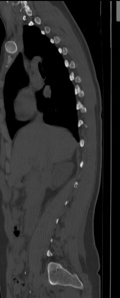 File:Chance fracture (Radiopaedia 45345-49372 Sagittal bone window 2).jpg
