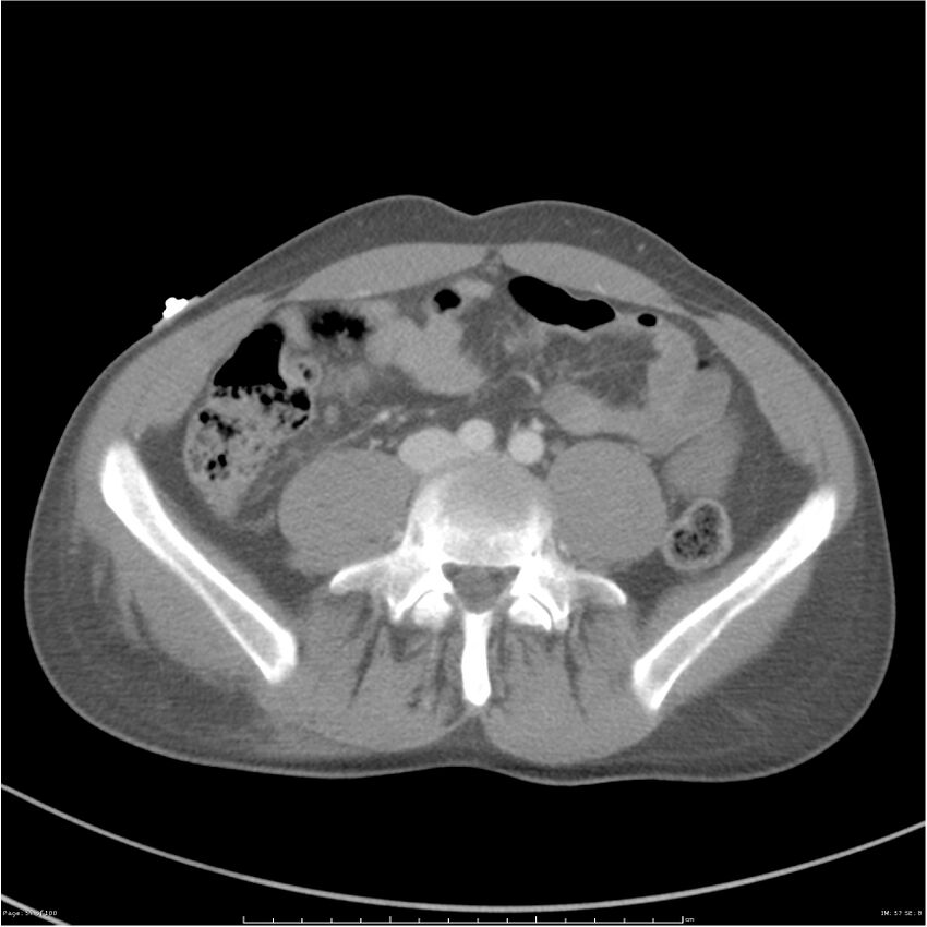 Chest and abdomen multi-trauma (Radiopaedia 26294-26426 bone window 57).jpg