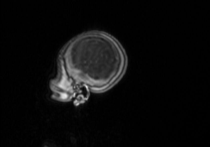 Chiari III malformation with occipital encephalocele (Radiopaedia 79446-92559 Sagittal T1 C+ mpr 59).jpg