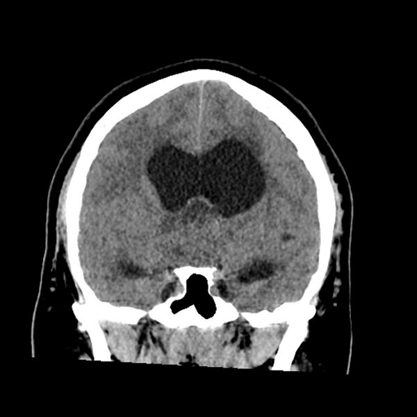 File:Chiasmatic-hypothalamic juvenile pilocytic astrocytoma (Radiopaedia 78533-91237 Coronal non-contrast 32).jpg