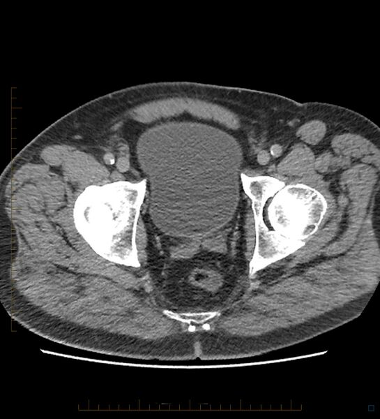 File:Chicken bone in anal canal (Radiopaedia 51490-57253 Axial non-contrast 3).jpg