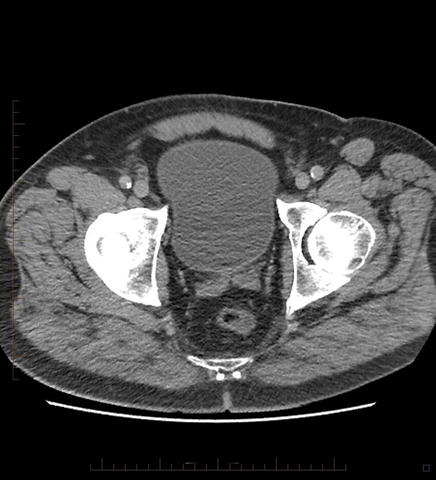 Chicken bone in anal canal (Radiopaedia 51490-57253 Axial non-contrast 3).jpg