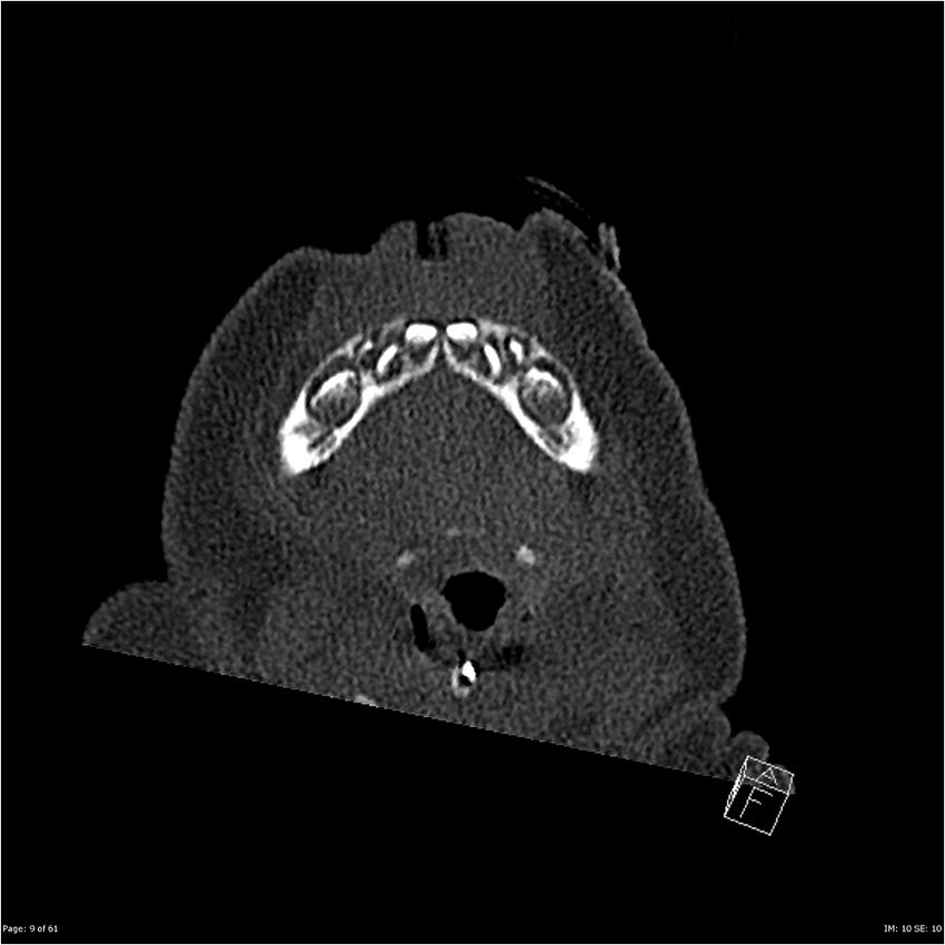 Choanal atresia (Radiopaedia 23492-23579 bone window 9).jpg