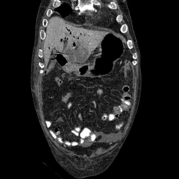 File:Cholangitis and abscess formation in a patient with cholangiocarcinoma (Radiopaedia 21194-21100 C 5).jpg