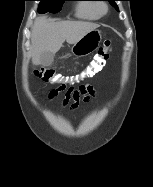 File:Cholecystitis with focal perforation and hepatic abscess (Radiopaedia 37189-38945 Coronal non-contrast 12).png