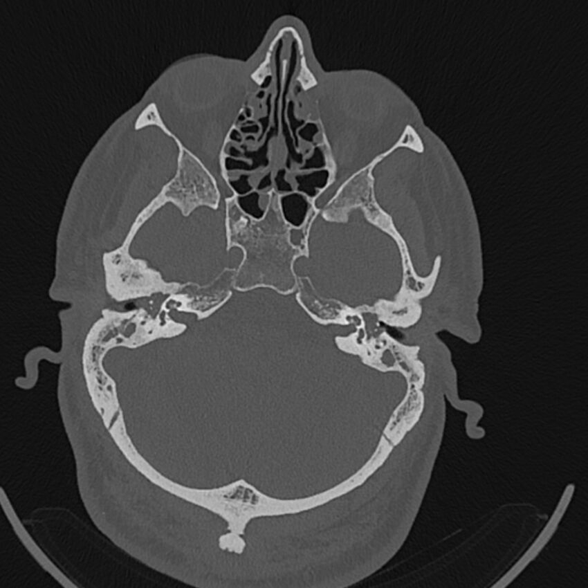 Cholesteatoma (Radiopaedia 68176-77673 Axial bone window 42).jpg