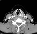 Chondrosarcoma - larynx (Radiopaedia 4588-6698 A 4).jpg