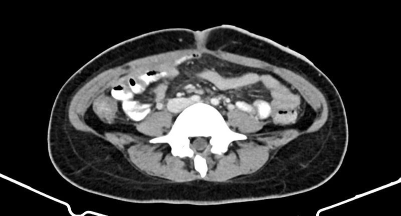 File:Choriocarcinoma liver metastases (Radiopaedia 74768-85766 A 131).jpg