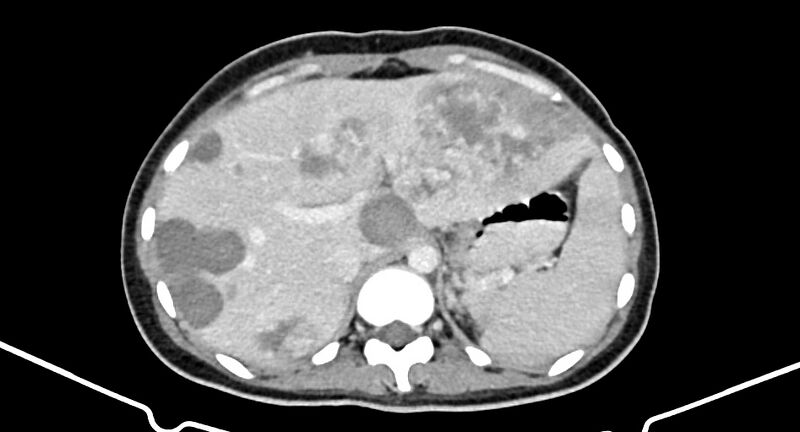 File:Choriocarcinoma liver metastases (Radiopaedia 74768-85766 A 59).jpg