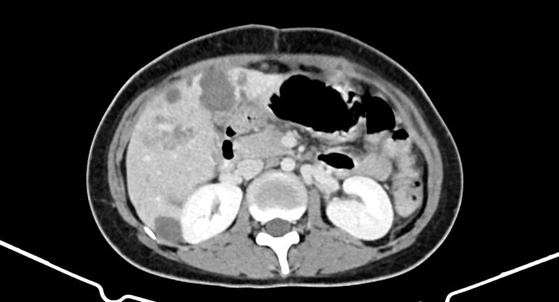 File:Choriocarcinoma liver metastases (Radiopaedia 74768-85766 A 91).jpg