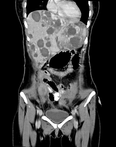 File:Choriocarcinoma liver metastases (Radiopaedia 74768-85766 B 34).jpg