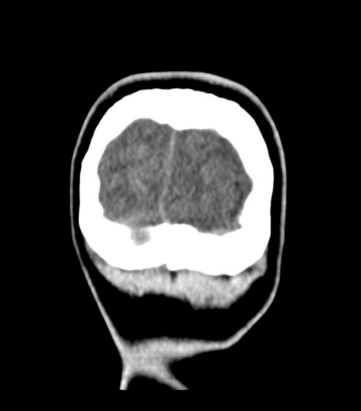 File:Choroid plexus carcinoma (Radiopaedia 91013-108552 Coronal non-contrast 81).jpg