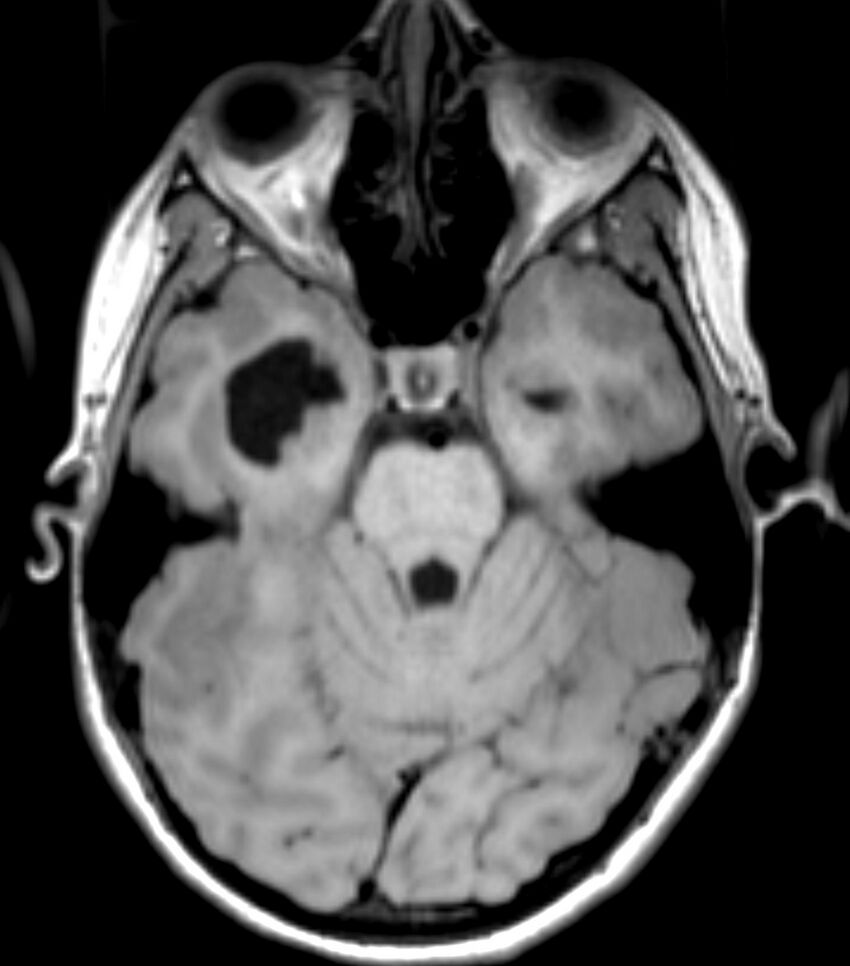 Choroid plexus carcinoma (Radiopaedia 91013-108553 Axial T1 63).jpg