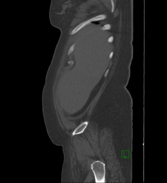 File:Chromophobe renal cell carcinoma (Radiopaedia 84239-99519 Sagittal bone window 96).jpg