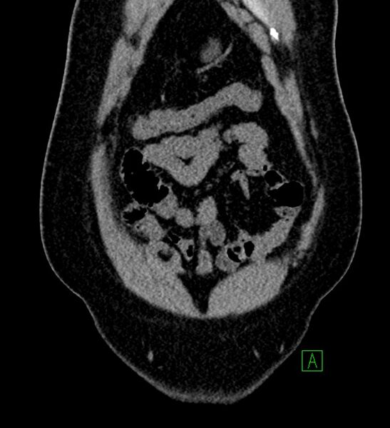 File:Chromophobe renal cell carcinoma (Radiopaedia 84286-99573 Coronal non-contrast 23).jpg