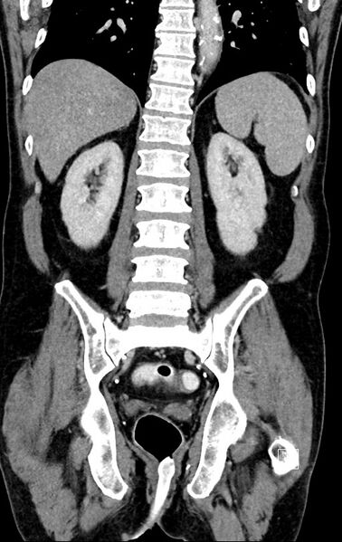 File:Chronic appendicitis complicated by appendicular abscess, pylephlebitis and liver abscess (Radiopaedia 54483-60700 C 58).jpg