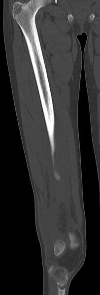 File:Chronic ostemyelitis of the femur with long sinus tract (Radiopaedia 74947-85982 Coronal bone window 34).jpg