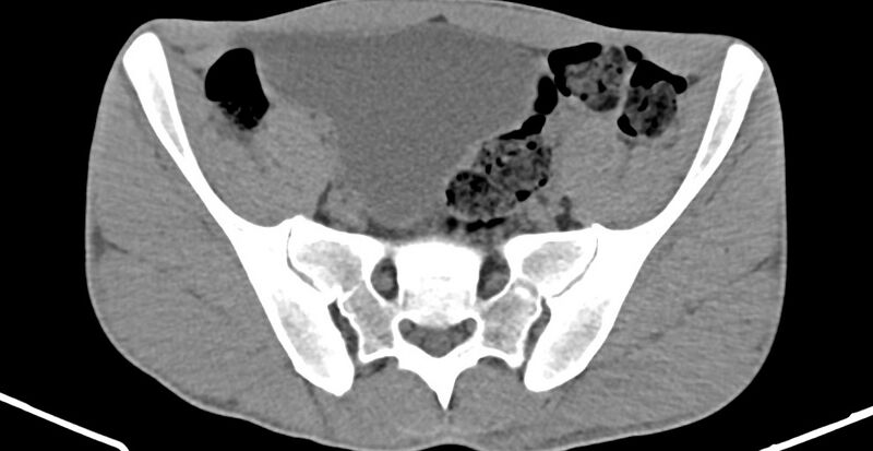 File:Chronic osteomyelitis (with sequestrum) (Radiopaedia 74813-85822 D 9).jpg