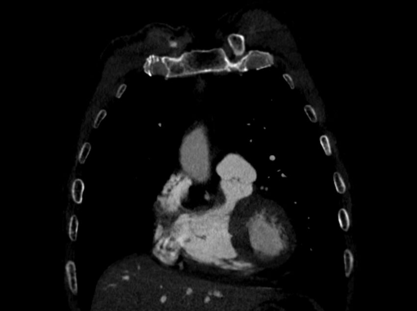 Chronic pulmonary embolism (Radiopaedia 91241-108843 A 19).jpg