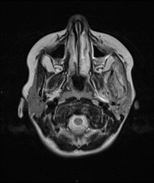File:Chronic reactive multifocal osteomyelitis (CRMO) - mandible (Radiopaedia 56405-63069 Axial T2 17).jpg