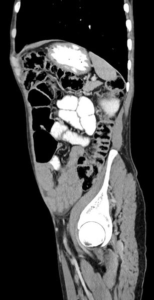 File:Chronic small bowel volvulus (Radiopaedia 75224-86322 C 39).jpg