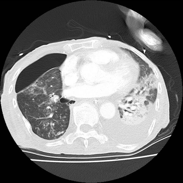 File:Clagett thoracotomy with bronchopleural fistula (Radiopaedia 29192-29587 Axial lung window 31).jpg