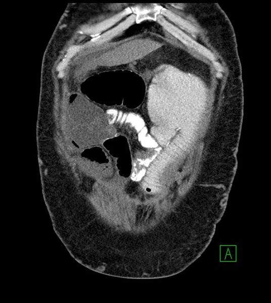File:Closed-loop small bowel obstruction-internal hernia (Radiopaedia 78439-91096 Coronal non-contrast 23).jpg