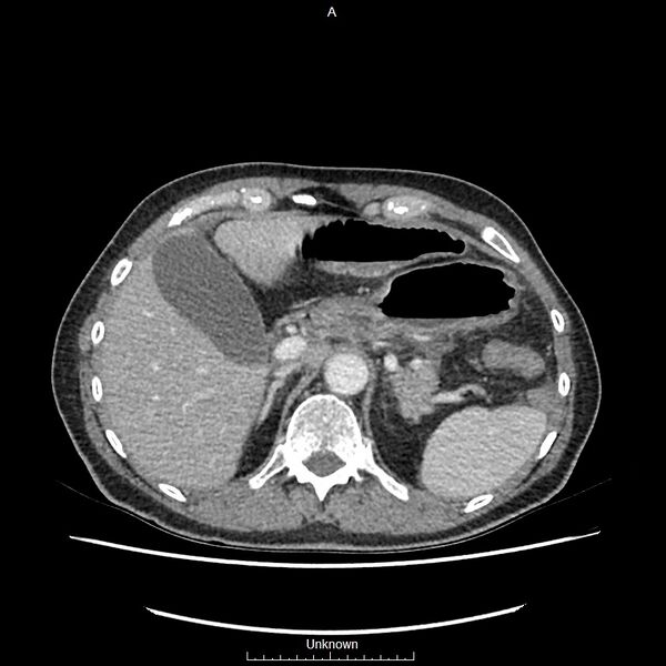 File:Closed loop bowel obstruction and ischemia (Radiopaedia 86959-103180 A 13).jpg