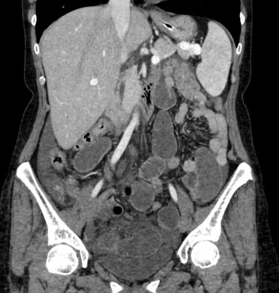 File:Closed loop small bowel obstruction (Radiopaedia 71211-81508 B 53).jpg