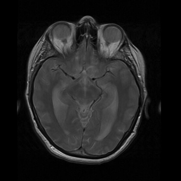File:Colloid cyst with hydrocephalus (Radiopaedia 9373-10065 Axial PD 8).jpg