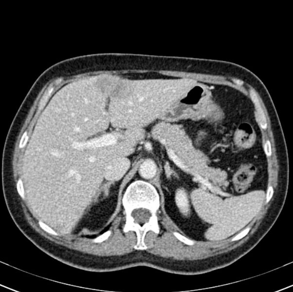 File:Colon carcinoma with hepatic metastases (Radiopaedia 29477-29961 A 30).jpg