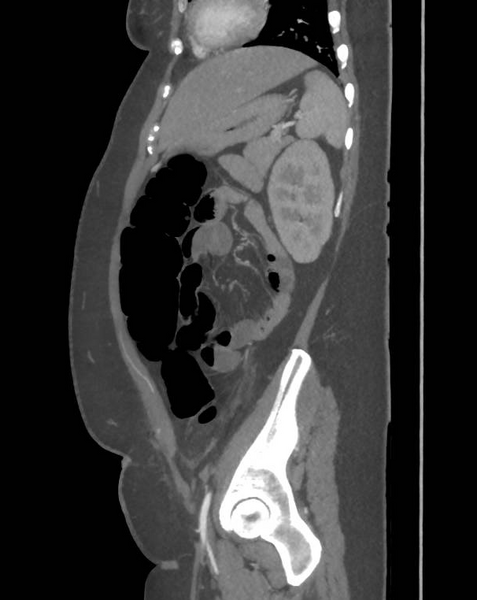 File:Colonic pseudo-obstruction (Radiopaedia 79752-92980 C 56).png