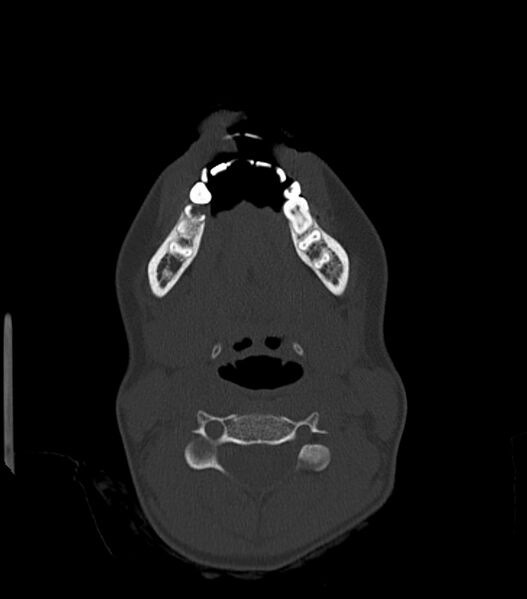 File:Nasoorbitoethmoid fracture (Radiopaedia 90044-107205 Axial 71).jpg