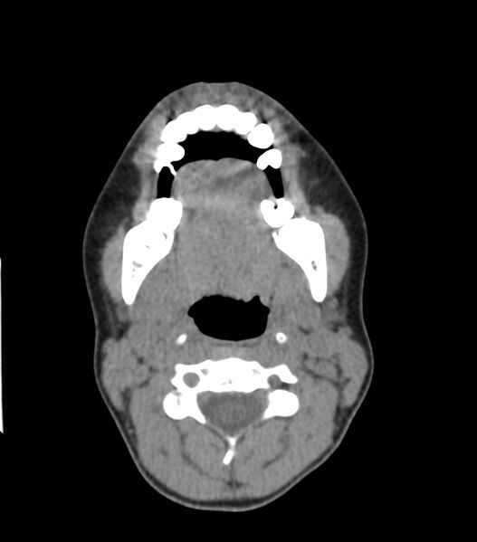 File:Nasoorbitoethmoid fracture (Radiopaedia 90044-107205 Axial non-contrast 72).jpg