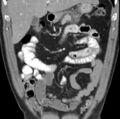 Necrotizing pancreatitis with acute necrotic collection (Radiopaedia 14470-14417 C 9).jpg