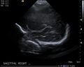 Neonatal intracranial hemorrhage - grade 3 (Radiopaedia 27279-27455 Longitudinal 2).jpg