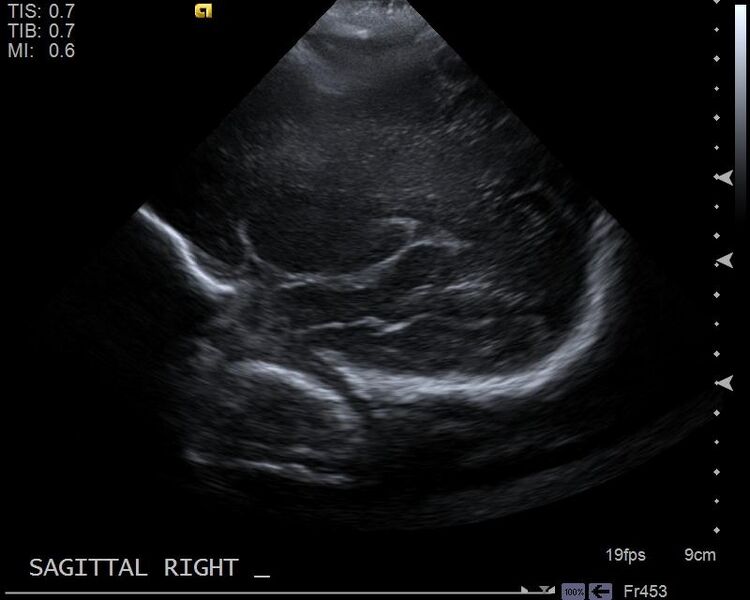 File:Neonatal intracranial hemorrhage - grade 3 (Radiopaedia 27279-27455 Longitudinal 2).jpg