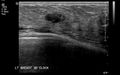 Neurofibromatosis of breast (Radiopaedia 5921-7462 D 1).jpg