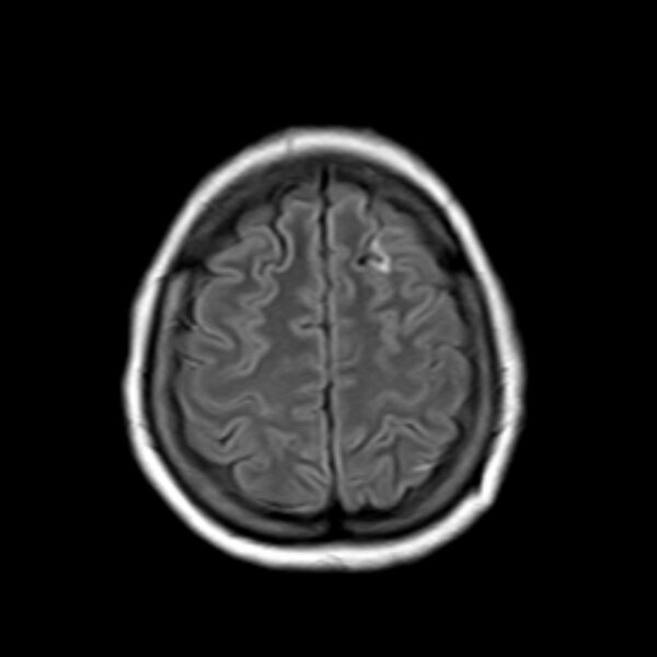 File:Neurofibromatosis type 2 (Radiopaedia 67470-76871 Axial FLAIR 19).jpg