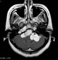 Neurofibromatosis type 2 - cranial and spinal involvement (Radiopaedia 5351-7111 Axial T1 C+ 3).jpg
