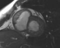 Non-compaction of the left ventricle (Radiopaedia 69436-79314 Short axis cine 147).jpg