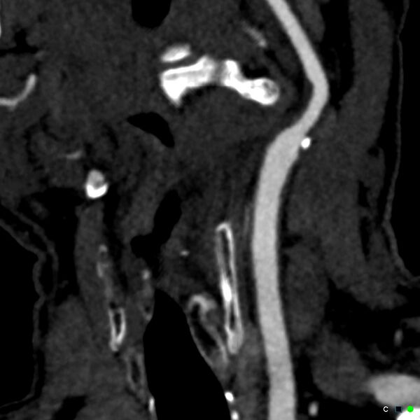File:Non-occlusive intraluminal internal carotid artery thrombus (Radiopaedia 37751-39658 C 68).jpg