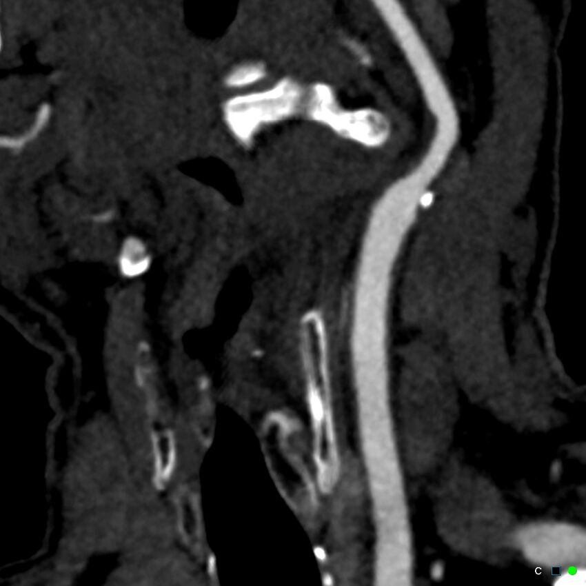 Non-occlusive intraluminal internal carotid artery thrombus (Radiopaedia 37751-39658 C 68).jpg