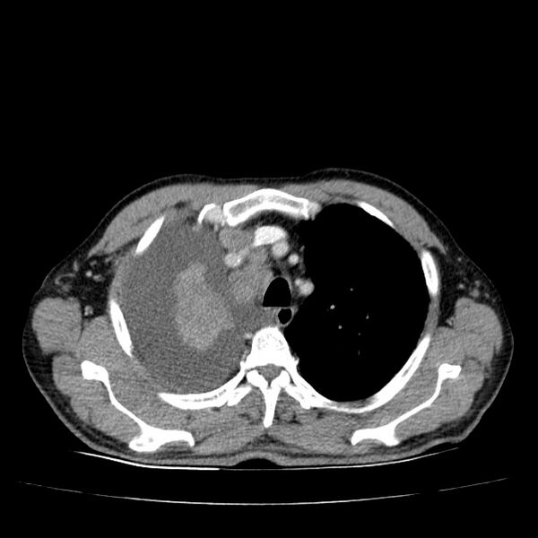 File:Non small-cell lung cancer (Radiopaedia 24467-24769 C+ delayed 17).jpg