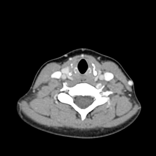 File:Normal CT of the neck (Radiopaedia 14575-14500 Axial C+ 47).jpg